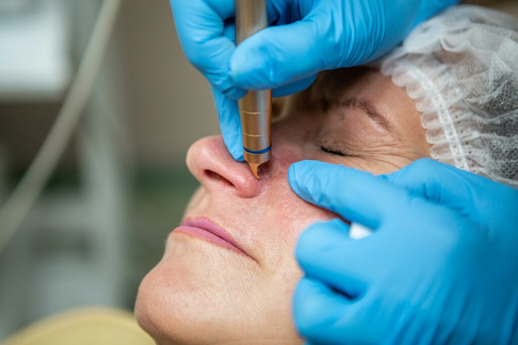 Removal of blood vessels by laser on the face of a Caucasian adult woman. Cosmetic procedure